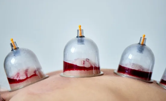 Chinese cupping