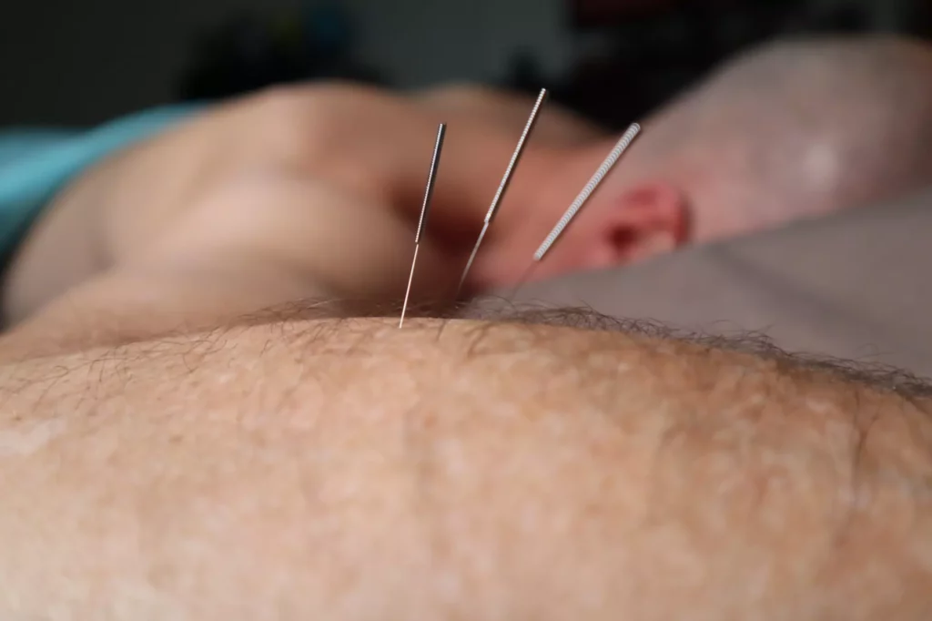 Acupuncture Boosts Your Immune System