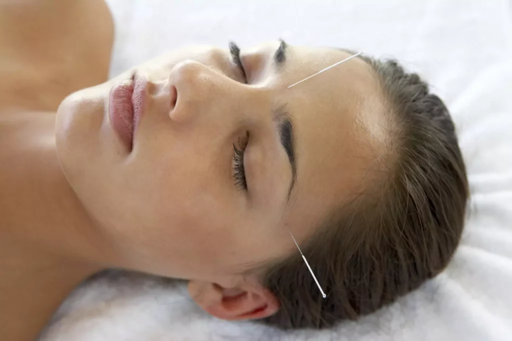 top 10 benefits of acupuncture