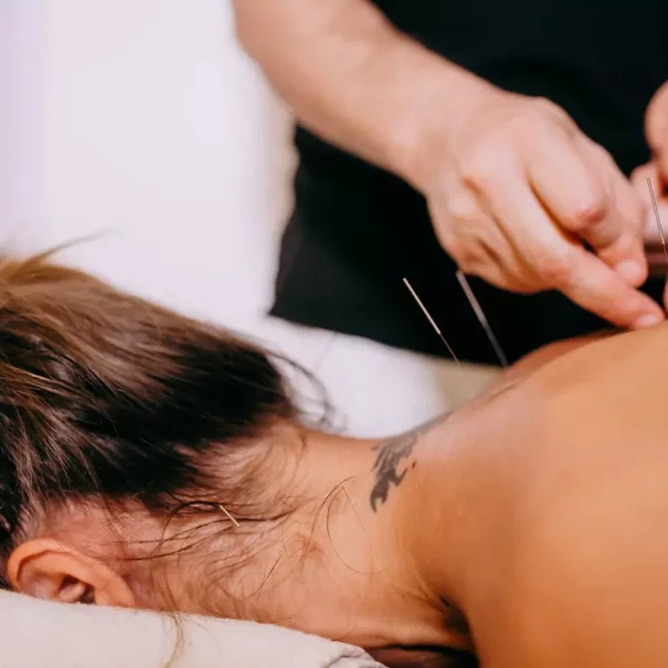 Can Acupuncture Help With Anxiety