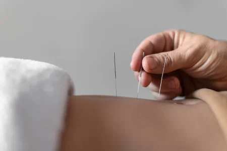 Acupuncture​ therapy