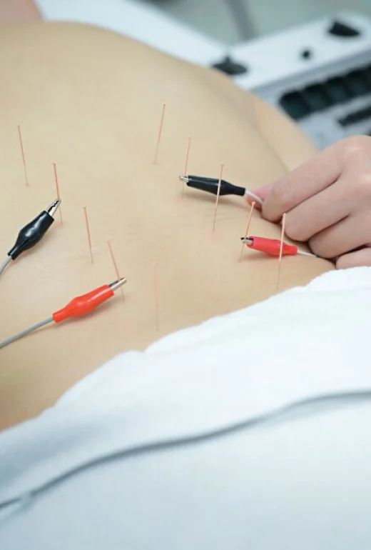 Electrotherapy acupuncture