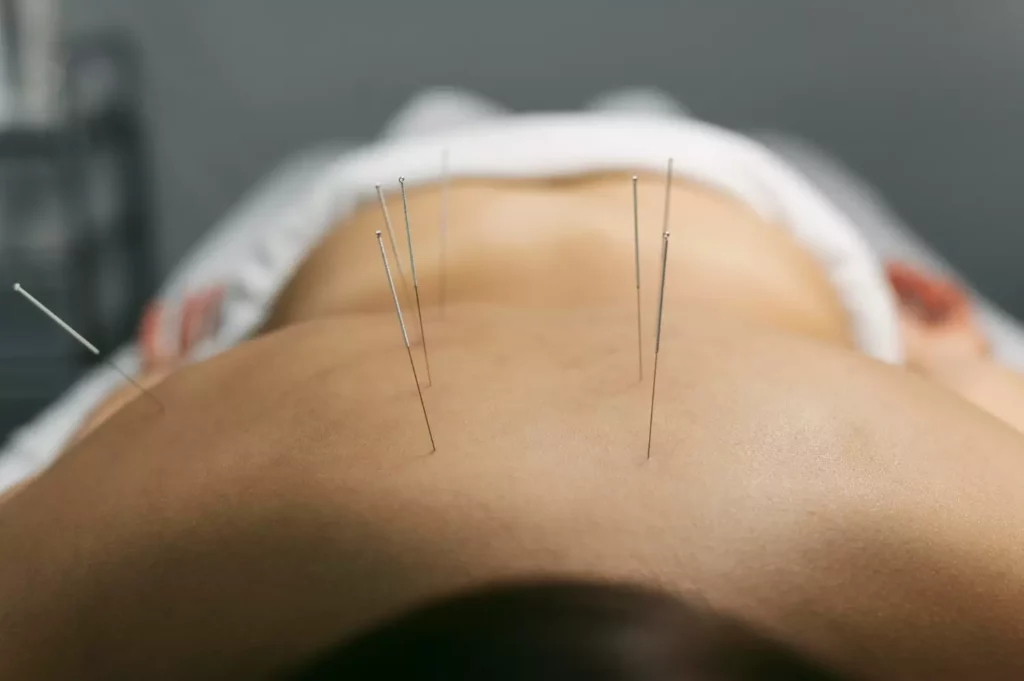 What to wear for an acupuncture session?