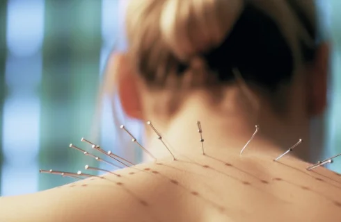 Acupuncture for neck pain and headaches