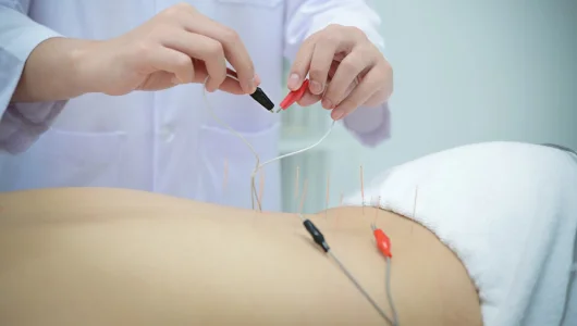Electroacupuncture in Clifton