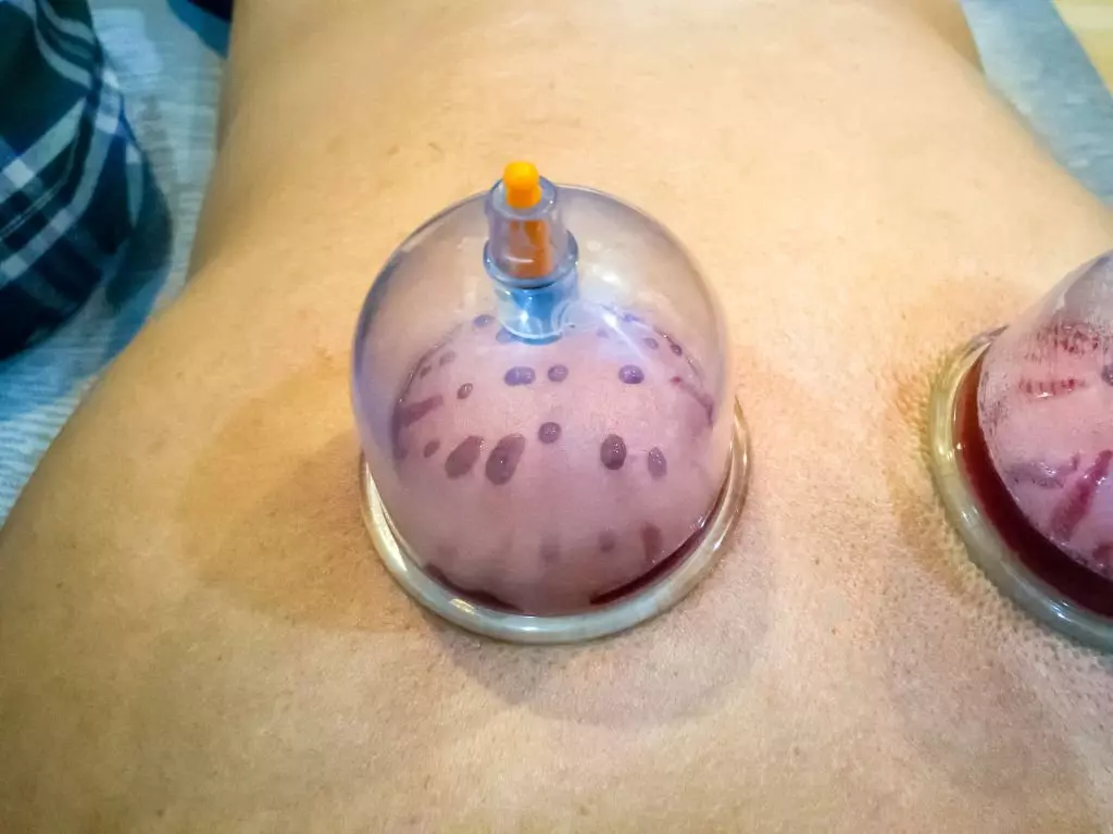 Wet cupping therapist in Clifton