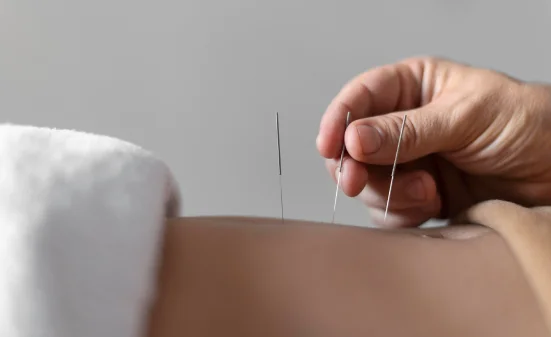 Acupuncture in Clifton
