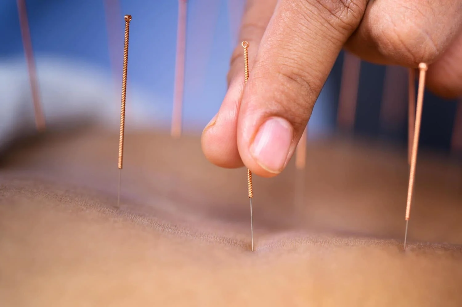 How does acupuncture help ED