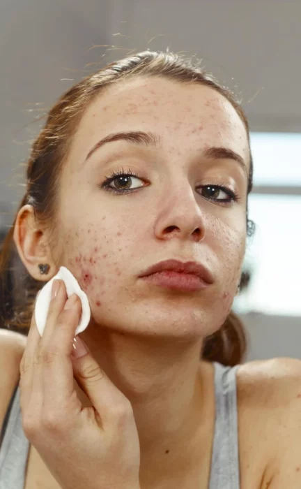 acupuncture and acne
