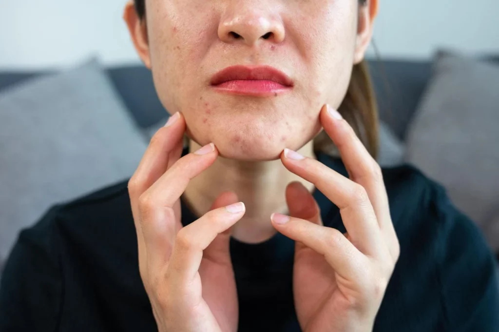 acupuncture for cystic acne