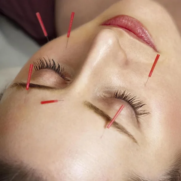 acupuncture points for acne