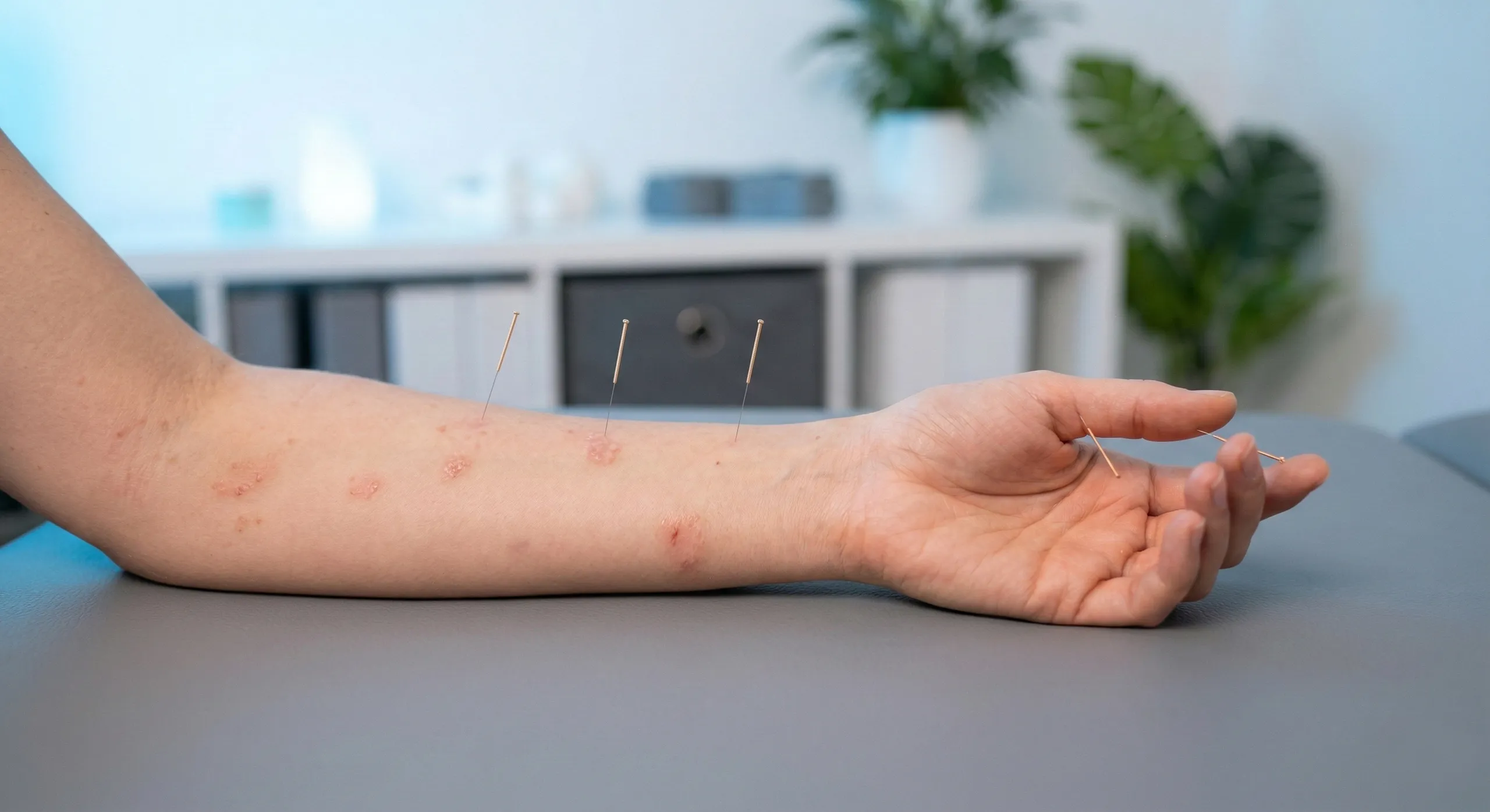 acupuncture for eczema nyc