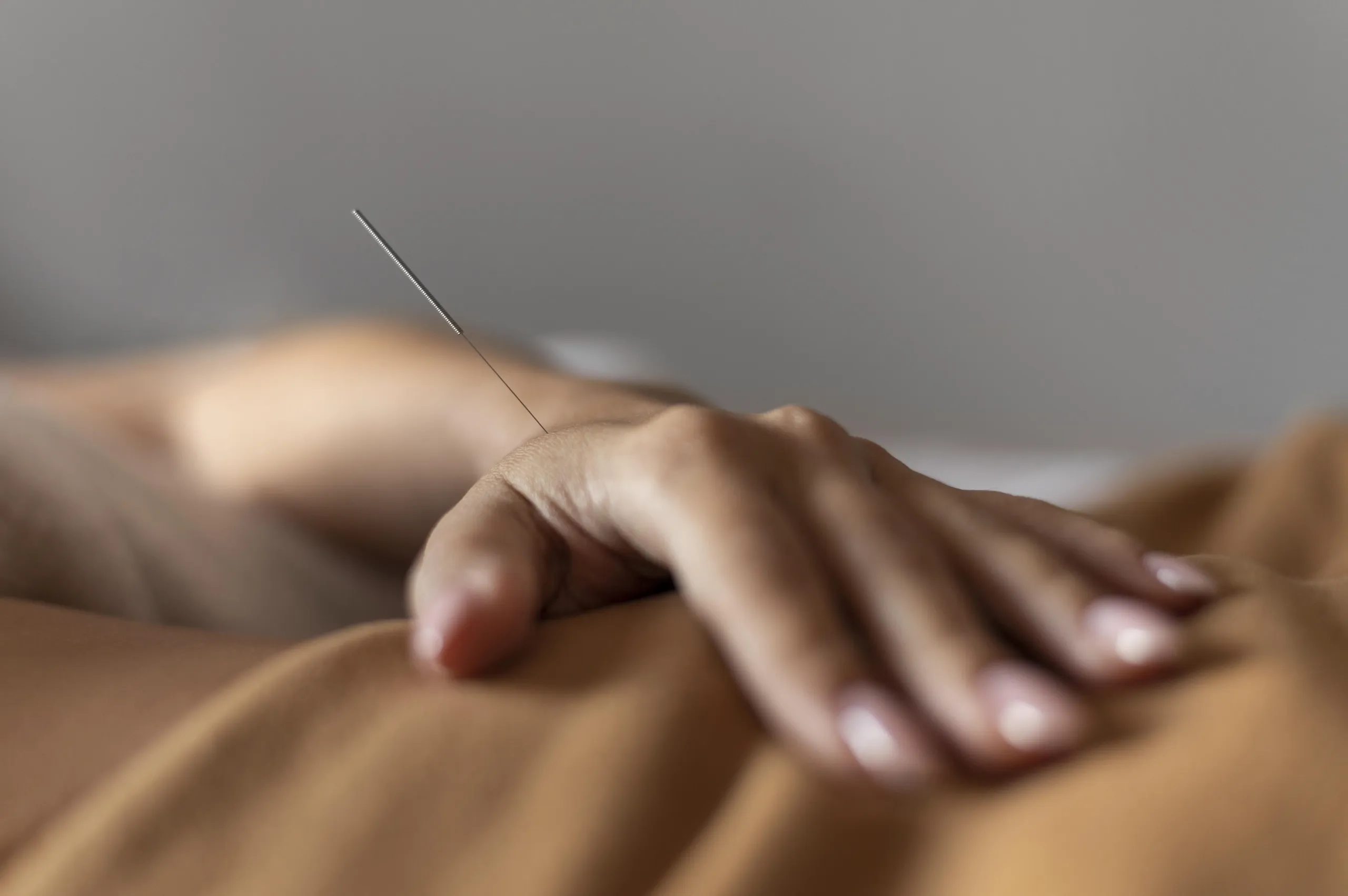 acupuncture vs dry needling