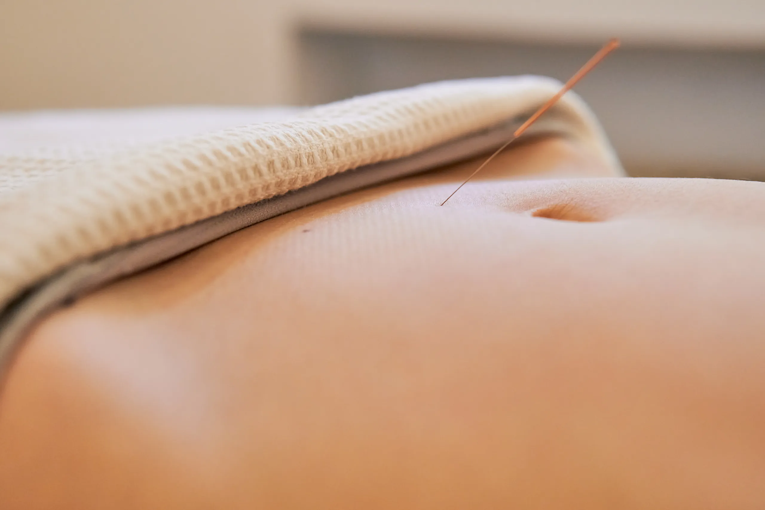 acupuncture pcos