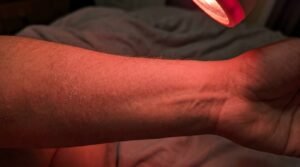 is red light therapy good for eczema