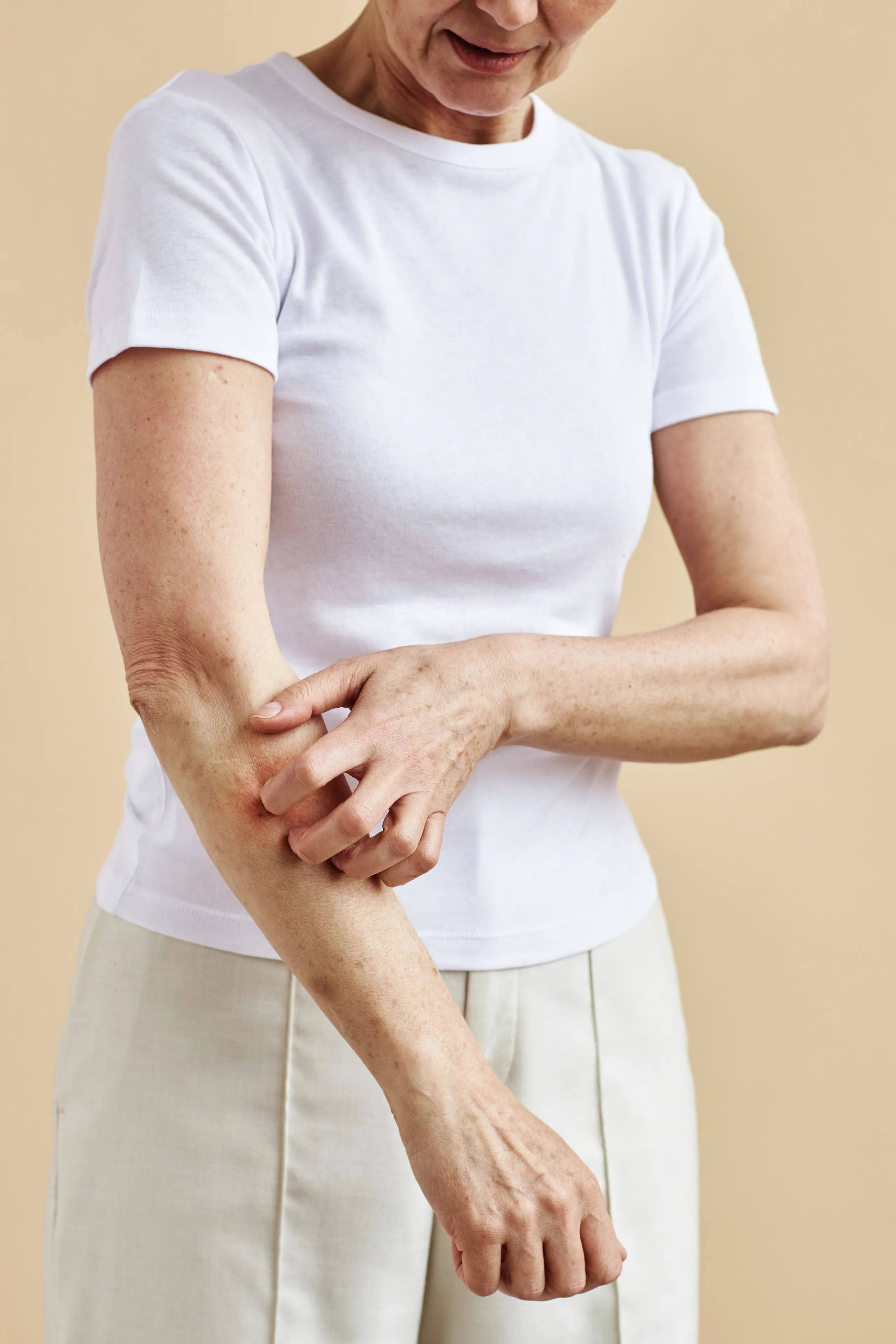 Acupuncture For Psoriasis