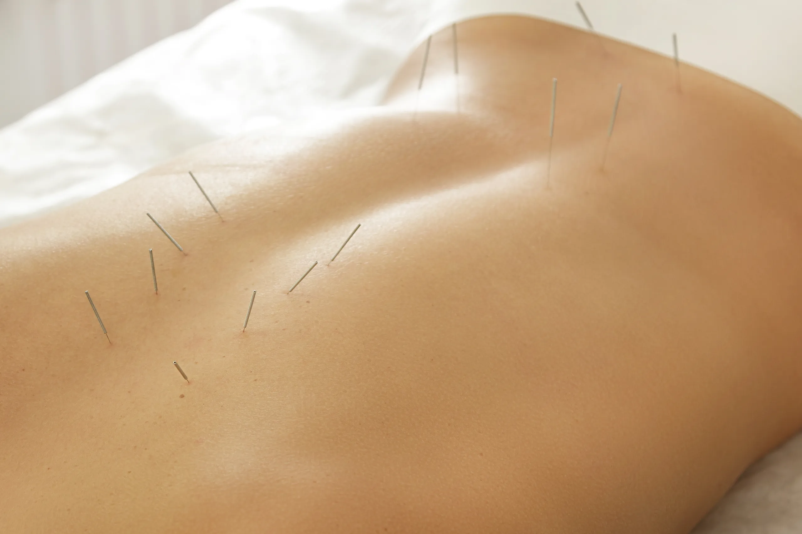 Acupuncture for Back Pain