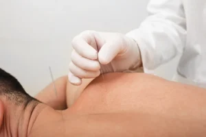 acupuncture sports medicine