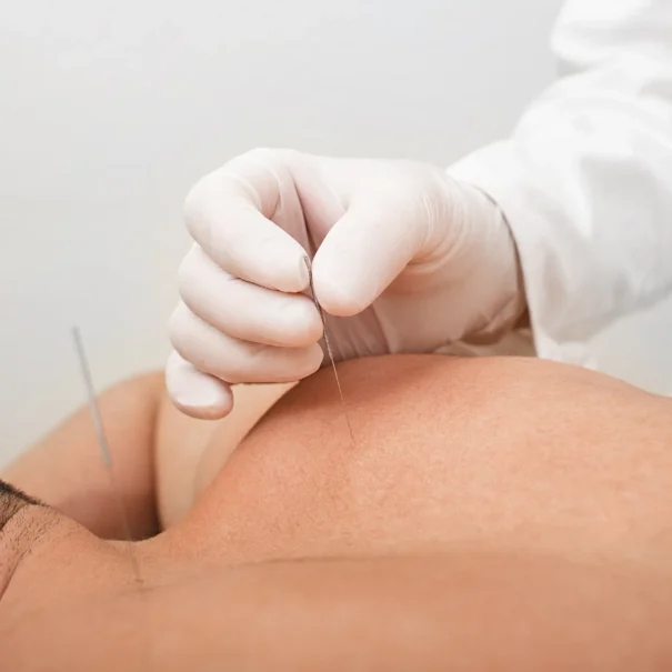acupuncture sports medicine