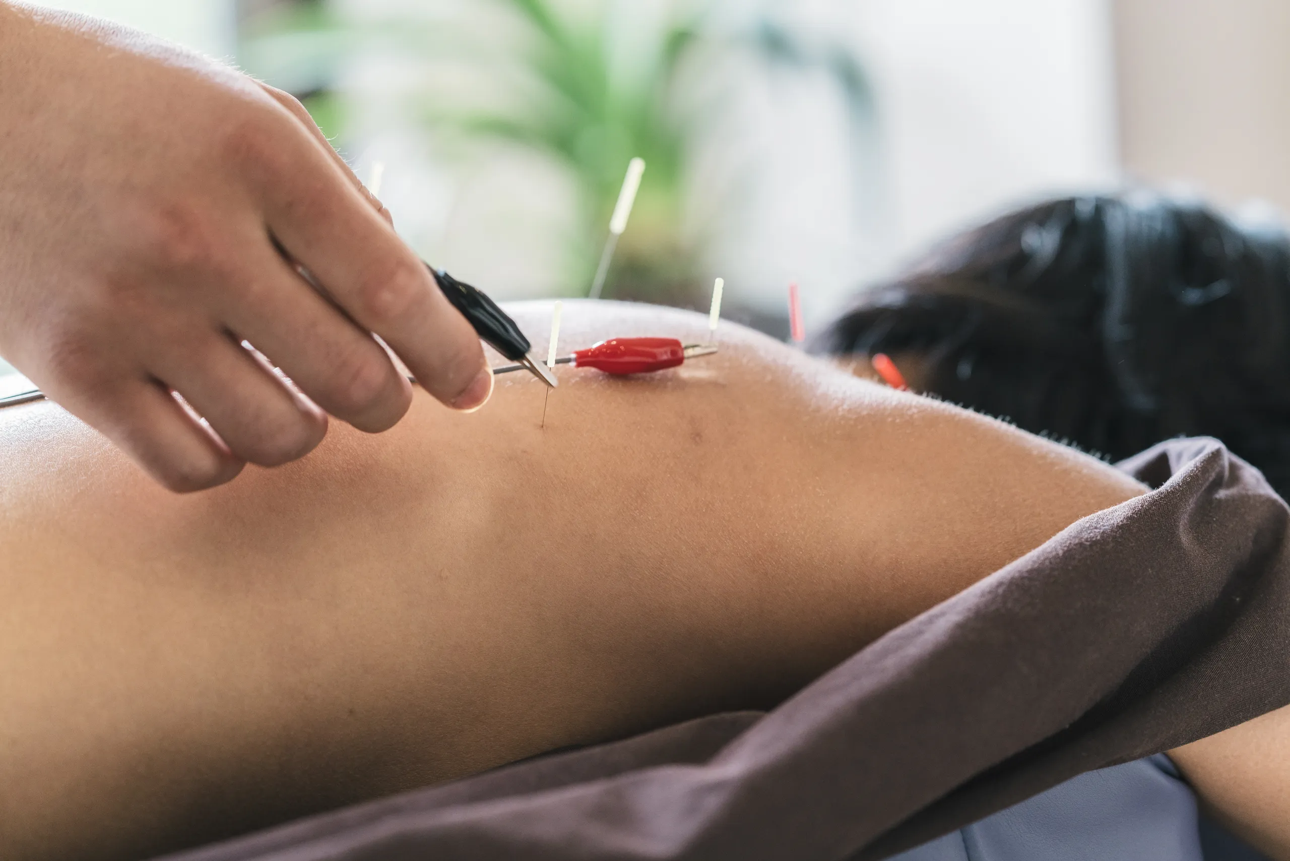 sports acupuncture